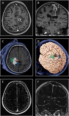 MRI-Based Risk Assessment for Incomplete Resection of Brain Metastases